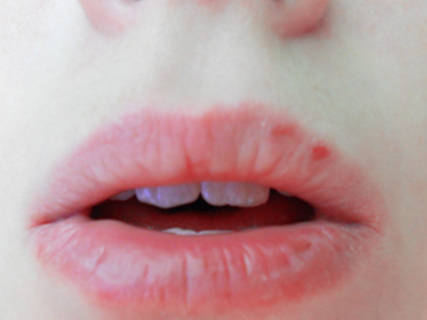 Herpes Labial Dicas para curar o Herpes + O meu método contra o vírus Girls Full Of Style Adesivos De Parede Infantil Super Herois ~ Herpes Labial Dicas para curar o Herpes + O meu método contra o vírus Girls Full Of Style